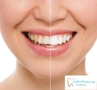 Teeth Whitening Sydney image 4